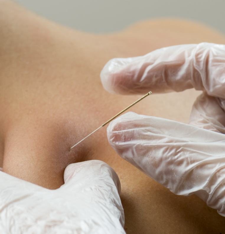 dry-needling-atrium-physical-therapy-las-cruces-nm