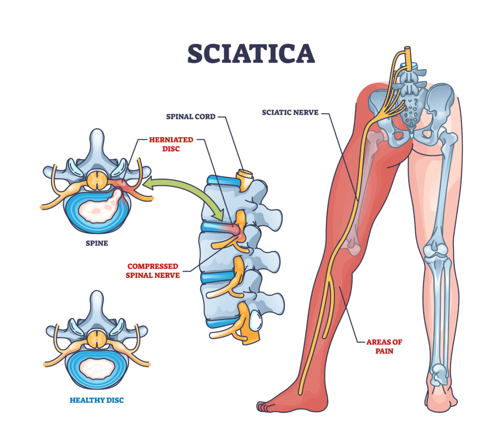 Physical Therapy Solutions for Sciatica and Back Pain